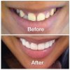 Snap-On-Smile provizorní zubní můstek