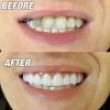 Instant Smile Kit - Dočasná silikonová náhrada zubů 30 ks
